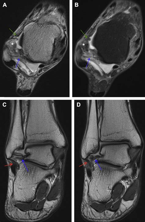 tests for ptfl tear|Imaging diagnosis for chronic lateral ankle ligament injury: a .